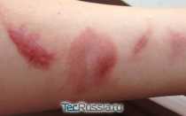 Рубцы от ожогов до и после шлифовки