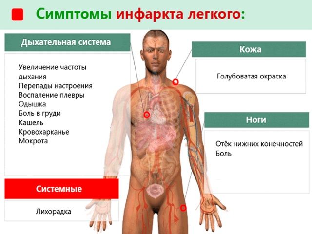 Инфаркт-пневмония признаки