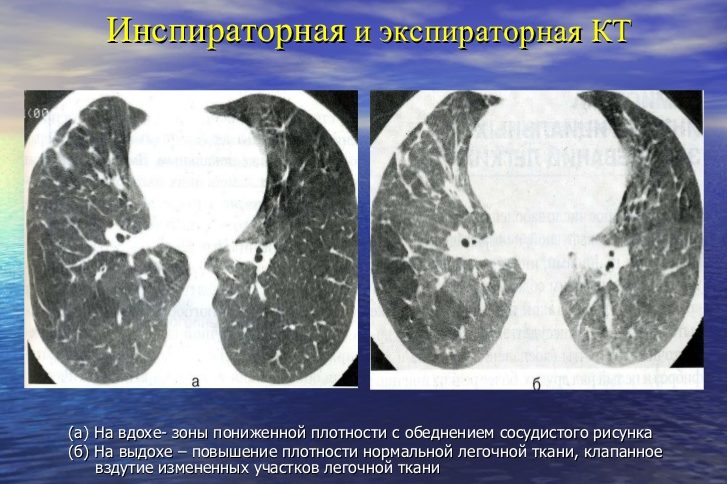Инспираторная и экспираторная КТ